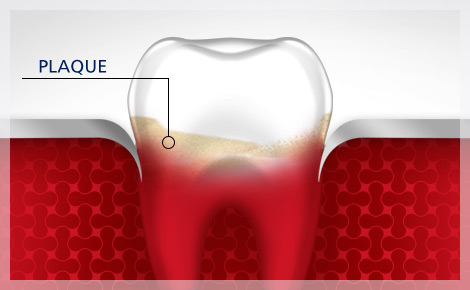 Dental Plaque Gum Disease parodontax Dental Plaque Gum Disease parodontax
