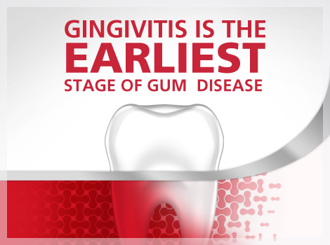 Image result for What Is Gingivitis?