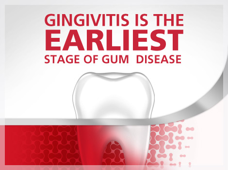 Gingivitis Early Stage Gum Disease parodontax Gingivitis Early Stage Gum Disease parodontax