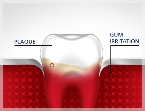 Gum Irritation Tooth Plaque Gum Disease parodontax Gum Irritation Tooth Plaque Gum Disease parodontax