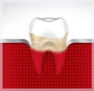 Bleeding Gums Tooth Gum Disease Stage 3 parodontax Bleeding Gums Tooth Gum Disease Stage 3 parodontax
