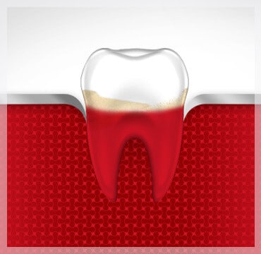 Inflamed Gums Bleeding Gums parodontax Inflamed Gums Bleeding Gums parodontax
